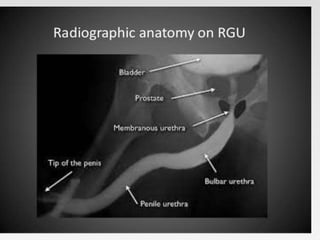 Retrograde urethrogram
 