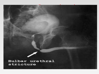 Retrograde urethrogram
 