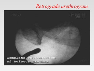 Retrograde urethrogram
 