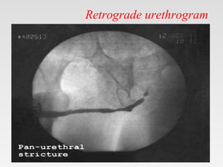 Retrograde urethrogram
 