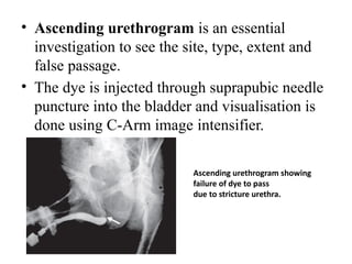 • Ascending urethrogram is an essential
investigation to see the site, type, extent and
false passage.
• The dye is injected through suprapubic needle
puncture into the bladder and visualisation is
done using C-Arm image intensifier.
Ascending urethrogram showing
failure of dye to pass
due to stricture urethra.
 