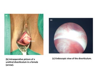 (b) Intraoperative picture of a
urethral diverticulum in a female
(arrow).
(c) Endoscopic view of the diverticulum.
 