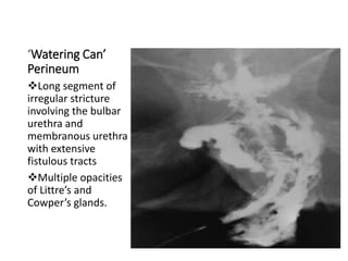 ‘Watering Can’
Perineum
Long segment of
irregular stricture
involving the bulbar
urethra and
membranous urethra
with extensive
fistulous tracts
Multiple opacities
of Littre’s and
Cowper’s glands.
 