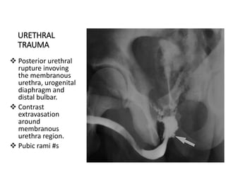 URETHRAL
TRAUMA
 Posterior urethral
rupture invoving
the membranous
urethra, urogenital
diaphragm and
distal bulbar.
 Contrast
extravasation
around
membranous
urethra region.
 Pubic rami #s
 