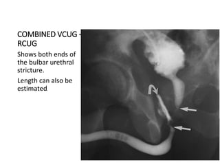 COMBINED VCUG +
RCUG
Shows both ends of
the bulbar urethral
stricture.
Length can also be
estimated.
 