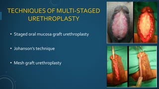 Urethral strictures | PPTX