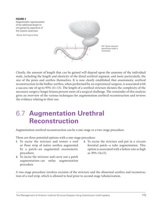 115
The Management of Anterior Urethral Stricture Disease Using Substitution Urethroplasty
Figure 3
Diagrammatic representation
of the additional length (in
cm) gained by separation of
the corpora cavernosa
(Mundy, BJUI Surgical Atlas)
N.B. figures represent
approximate length in
centimetres
Clearly, the amount of length that can be gained will depend upon the anatomy of the individual
male, including the length and elasticity of the distal urethral segment, and more particularly, the
size of the penis and urethra themselves. It is now clearly established that anastomotic urethral
reconstruction in the bulbar urethra, when performed by an experienced surgeon, is associated with
a success rate of up to 95% (11–13). The length of a urethral stricture dictates the complexity of the
necessary surgery; longer lesions present more of a surgical challenge. The remainder of this analysis
gives an overview of the various techniques for augmentation urethral reconstruction and reviews
the evidence relating to their use.
6.7 Augmentation Urethral
Reconstruction
Augmentation urethral reconstruction can be a one-stage or a two-stage procedure.
There are three potential options with a one-stage procedure:
1. To excise the stricture and restore a roof
or floor strip of native urethra augmented
by a patch–an augmented anastomotic
procedure;
2. To incise the stricture and carry out a patch
augmentation–an onlay augmentation
procedure
3. To excise the stricture and put in a circum-
ferential patch–a tube augmentation. This
option is associated with a failure rate as high
as 30% (14,15).
A two-stage procedure involves excision of the stricture and the abnormal urethra and reconstruc-
tion of a roof strip, which is allowed to heal prior to second-stage tubularization.
 