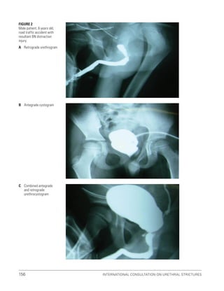 International Consultation on Urethral Strictures
156
C Combined antegrade
and retrograde
urethrocystogram
FiGURE 2
Male patient, 6 years old,
road traffic accident with
resultant BN distraction
injury.
A Retrograde urethrogram
B Antegrade cystogram
 