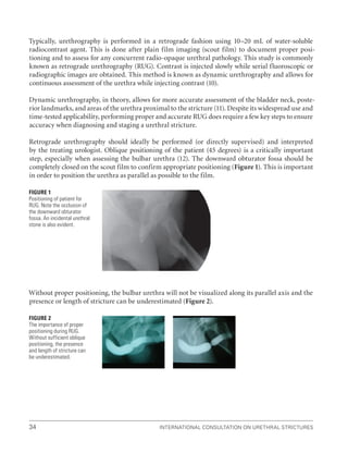 International Consultation on Urethral Strictures
34
Typically, urethrography is performed in a retrograde fashion using 10–20 mL of water-soluble
radiocontrast agent. This is done after plain film imaging (scout film) to document proper posi-
tioning and to assess for any concurrent radio-opaque urethral pathology. This study is commonly
known as retrograde urethrography (RUG). Contrast is injected slowly while serial fluoroscopic or
radiographic images are obtained. This method is known as dynamic urethrography and allows for
continuous assessment of the urethra while injecting contrast (10).
Dynamic urethrography, in theory, allows for more accurate assessment of the bladder neck, poste-
rior landmarks, and areas of the urethra proximal to the stricture (11). Despite its widespread use and
time-tested applicability, performing proper and accurate RUG does require a few key steps to ensure
accuracy when diagnosing and staging a urethral stricture.
Retrograde urethrography should ideally be performed (or directly supervised) and interpreted
by the treating urologist. Oblique positioning of the patient (45 degrees) is a critically important
step, especially when assessing the bulbar urethra (12). The downward obturator fossa should be
completely closed on the scout film to confirm appropriate positioning (Figure 1). This is important
in order to position the urethra as parallel as possible to the film.
Without proper positioning, the bulbar urethra will not be visualized along its parallel axis and the
presence or length of stricture can be underestimated (Figure 2).
Figure 1
Positioning of patient for
RUG. Note the occlusion of
the downward obturator
fossa. An incidental urethral
stone is also evident.
Figure 2
The importance of proper
positioning during RUG.
Without sufficient oblique
positioning, the presence
and length of stricture can
be underestimated.
 
