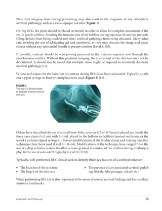 Evaluation and Follow-Up 35
Plain film imaging done during positioning may also assist in the diagnosis of any concurrent
urethral pathology, such as a radio-opaque calculus (Figure 1).
During RUG, the penis should be placed on stretch in order to allow for complete assessment of the
entire penile urethra. Avoiding the introduction of air bubbles during injection of contrast prevents
filling defects from being masked and other urethral pathology from being obscured. Many advo-
cate avoiding the use of lubricating gel and anesthetic, as they may obscure the image and cause
edema without any substantial benefit to patient comfort (Level 4) (10).
If possible, contrast should be seen passing proximal to the stricture segment and through the
membranous urethra. Without this proximal imaging, the true extent of the stricture may not be
determined. It should also be noted that multiple views might be required to accurately delineate
urethral pathology (11).
Various techniques for the injection of contrast during RUG have been advocated. Typically, a cath-
eter-tipped syringe or Brodny clamp has been used (Figure 3) (13).
Others have described the use of a small-bore Foley catheter (12 or 14 French) placed just inside the
fossa navicularis (1–2 cm) with 2–3 mL placed in the balloon to facilitate luminal occlusion, or the
use of a catheter-tipped syringe (1). Several modifications of the Brodny clamp and varying injection
techniques have been used (Level 4) (14–16). Modifications of the technique have ranged from the
use of a drip infusion system (to allow a more gradual distension of the urethra during urethrogra-
phy) to the use of auto-urethrography (Level 4) (17,18).
Typically, well-performed RUG should seek to identify three key features of a urethral stricture:
ƒ
ƒ The location of the stricture
ƒ
ƒ The length of the stricture
ƒ
ƒ The presence of any associated urethral pathol-
ogy (fistula, false passages, calculi, etc.)
When performing RUG, it is also important to be aware of several normal findings and key urethral
anatomic landmarks.
Figure 3
The use of a Brodny clamp
to evaluate a penile urethral
stricture.
 