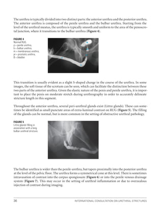 International Consultation on Urethral Strictures
36
The urethra is typically divided into two distinct parts: the anterior urethra and the posterior urethra.
The anterior urethra is composed of the penile urethra and the bulbar urethra. Starting from the
level of the urethral meatus, the urethra is typically smooth and uniform to the area of the penoscro-
tal junction, where it transitions to the bulbar urethra (Figure 4).
This transition is usually evident as a slight S-shaped change in the course of the urethra. In some
images, the soft tissue of the scrotum can be seen, which can facilitate the distinction between these
two parts of the anterior urethra. Given the elastic nature of the penis and penile urethra, it is impor-
tant to place the penis on moderate stretch during urethrography in order to accurately delineate
stricture length in this segment.
Throughout the anterior urethra, several peri-urethral glands exist (Littre glands). These can some-
times be identified as small punctate areas of extra-luminal contrast on RUG (Figure 5). The filling
of the glands can be normal, but is more common in the setting of obstructive urethral pathology.
The bulbar urethra is wider than the penile urethra, but tapers proximally into the posterior urethra
at the level of the pelvic floor. The urethra forms a symmetrical cone at this level. There is sometimes
intravasation of contrast into the corpus spongiosum (Figure 6) or into the penile venous drainage
system (Figure 7). This may occur in the setting of urethral inflammation or due to overzealous
injection of contrast during imaging.
Figure 4
Normal RUG.
p = penile urethra,
b = bulbar urethra,
m = membranous urethra,
pr = prostatic urethra,
B = bladder
Figure 5
Littre glands filling in
association with a long
bulbar urethral stricture.
 