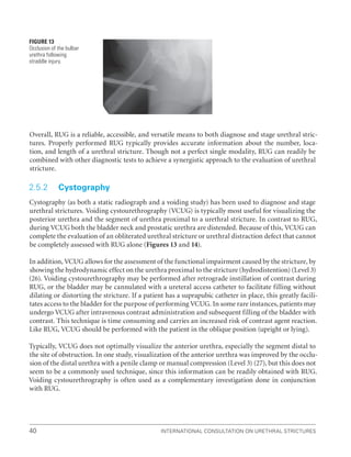 International Consultation on Urethral Strictures
40
Overall, RUG is a reliable, accessible, and versatile means to both diagnose and stage urethral stric-
tures. Properly performed RUG typically provides accurate information about the number, loca-
tion, and length of a urethral stricture. Though not a perfect single modality, RUG can readily be
combined with other diagnostic tests to achieve a synergistic approach to the evaluation of urethral
stricture.
2.5.2 Cystography
Cystography (as both a static radiograph and a voiding study) has been used to diagnose and stage
urethral strictures. Voiding cystourethrography (VCUG) is typically most useful for visualizing the
posterior urethra and the segment of urethra proximal to a urethral stricture. In contrast to RUG,
during VCUG both the bladder neck and prostatic urethra are distended. Because of this, VCUG can
complete the evaluation of an obliterated urethral stricture or urethral distraction defect that cannot
be completely assessed with RUG alone (Figures 13 and 14).
In addition, VCUG allows for the assessment of the functional impairment caused by the stricture, by
showing the hydrodynamic effect on the urethra proximal to the stricture (hydrodistention) (Level 3)
(26). Voiding cystourethrography may be performed after retrograde instillation of contrast during
RUG, or the bladder may be cannulated with a ureteral access catheter to facilitate filling without
dilating or distorting the stricture. If a patient has a suprapubic catheter in place, this greatly facili-
tates access to the bladder for the purpose of performing VCUG. In some rare instances, patients may
undergo VCUG after intravenous contrast administration and subsequent filling of the bladder with
contrast. This technique is time consuming and carries an increased risk of contrast agent reaction.
Like RUG, VCUG should be performed with the patient in the oblique position (upright or lying).
Typically, VCUG does not optimally visualize the anterior urethra, especially the segment distal to
the site of obstruction. In one study, visualization of the anterior urethra was improved by the occlu-
sion of the distal urethra with a penile clamp or manual compression (Level 3) (27), but this does not
seem to be a commonly used technique, since this information can be readily obtained with RUG.
Voiding cystourethrography is often used as a complementary investigation done in conjunction
with RUG.
Figure 13
Occlusion of the bulbar
urethra following
straddle injury.
 