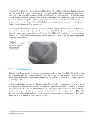 Evaluation and Follow-Up 41
Cystography without the voiding component has little place in the staging and diagnosis of most
anterior urethral strictures. However, static cystography can be useful in assessing urethral distrac-
tion defects due to a pelvic fracture-related urethral injury. In many instances, urethral distraction
defects may be completely obliterated and associated with significant nerve injury. Typically, a patient
has an indwelling suprapubic catheter, and in some cases may be unable to void for the purposes of
outlining the posterior urethra during VCUG. In these instances a static cystogram may still provide
insight into the integrity of the bladder neck.
Ultimately, the finding of an open bladder neck at rest on cystogram may indicate a higher risk of
incontinence after establishing urethral patency (Level 3) (28–31). In one series, the risk of post-
operative incontinence was estimated at 53% when the bladder neck was found to be open on cystog-
raphy (29). Therefore, when assessing urethral distraction defects due to pelvic fracture, a cystogram
is highly recommended.
2.5.3 Cystoscopy
Despite its widespread use, cystoscopy is a relatively under-reported modality for urethral stric-
ture assessment in the current urological literature. As a diagnostic modality, cystoscopy has
been considered the gold standard for determining the presence or absence of a urethral stricture
(Level 3) (19–21).
Cystoscopy has been reported to allow detection of a urethral stricture prior to the occurrence of
findings with other studies, such as uroflowmetry and symptom assessment (Level 3) (32). However,
cystoscopy alone does not allow for complete visual staging in terms of stricture length and exact
location, since most significant strictures are smaller in calibre than most cystoscopes (Figure 15).
In some cases, the use of a pediatric cystoscope or ureteroscope can allow assessment of the urethra
proximal to strictures of the distal (penile) urethra.
Figure 14
The combined use of RUG
and VCUG to stage an
obliterative bulbar
urethral stricture.
 
