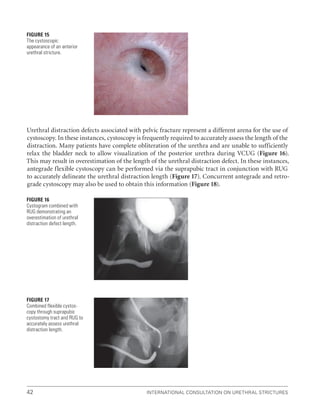 International Consultation on Urethral Strictures
42
Urethral distraction defects associated with pelvic fracture represent a different arena for the use of
cystoscopy. In these instances, cystoscopy is frequently required to accurately assess the length of the
distraction. Many patients have complete obliteration of the urethra and are unable to sufficiently
relax the bladder neck to allow visualization of the posterior urethra during VCUG (Figure 16).
This may result in overestimation of the length of the urethral distraction defect. In these instances,
antegrade flexible cystoscopy can be performed via the suprapubic tract in conjunction with RUG
to accurately delineate the urethral distraction length (Figure 17). Concurrent antegrade and retro-
grade cystoscopy may also be used to obtain this information (Figure 18).
Figure 15
The cystoscopic
appearance of an anterior
urethral stricture.
Figure 16
Cystogram combined with
RUG demonstrating an
overestimation of urethral
distraction defect length.
Figure 17
Combined flexible cystos-
copy through suprapubic
cystostomy tract and RUG to
accurately assess urethral
distraction length.
 