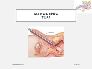 11/08/2025
Professor Bhavani Rao
IATROGENIC
TURP
 