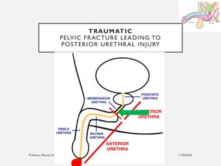 11/08/2025
Professor Bhavani Rao
TRAUMATIC
PELVIC FRACTURE LEADING TO
POSTERIOR URETHRAL INJURY
 