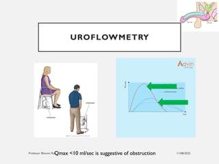 11/08/2025
Professor Bhavani Rao
UROFLOWMETRY
Qmax <10 ml/sec is suggestive of obstruction
 