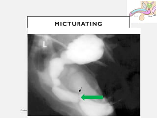 11/08/2025
Professor Bhavani Rao
MICTURATING
CYSTOURETHROGRAM (MCU
 