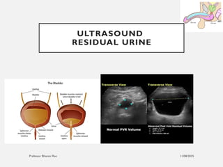 11/08/2025
Professor Bhavani Rao
ULTRASOUND
RESIDUAL URINE
 