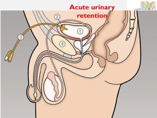 11/08/2025
Professor Bhavani Rao
Acute urinary
retention
 
