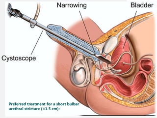 11/08/2025
Professor Bhavani Rao
Preferred treatment for a short bulbar
urethral stricture (<1.5 cm):
 