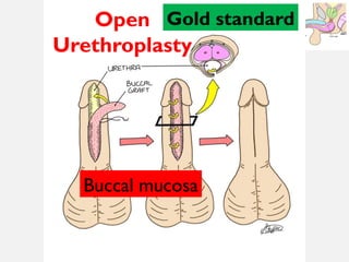 11/08/2025
Professor Bhavani Rao
Open
Urethroplasty
Gold standard
Buccal mucosa
 