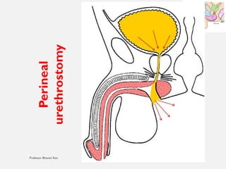 11/08/2025
Professor Bhavani Rao
Perineal
urethrostomy
 