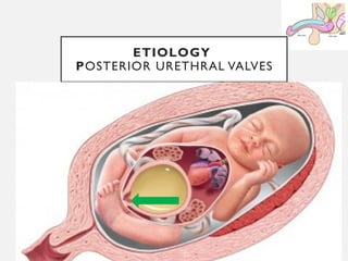 11/08/2025
Professor Bhavani Rao
ETIOLOGY
POSTERIOR URETHRAL VALVES
 