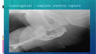 Investigation – complete urethral rupture
 