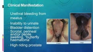 Clinical Manifestation
• Urethral bleeding from
meatus
• Inability to urinate
• Bladder distention
• Scrotal, perineal
and/or penile
swelling, “butterfly
haematoma”
• High riding prostate
 