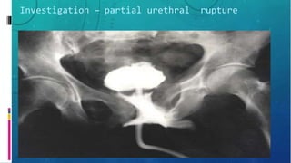 Investigation – partial urethral rupture
 