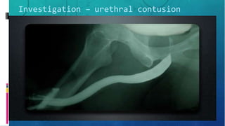 Investigation – urethral contusion
 
