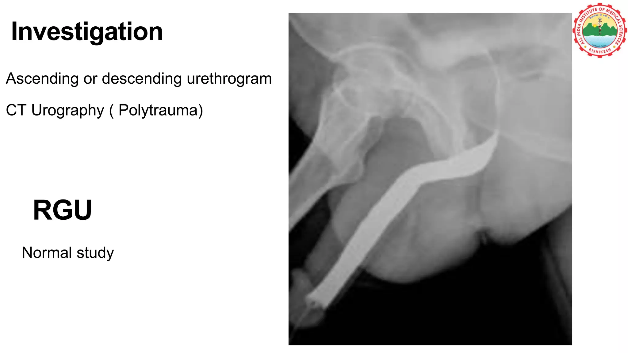 Normal study
RGU
22
Investigation
Ascending or descending urethrogram
CT Urography ( Polytrauma)
 