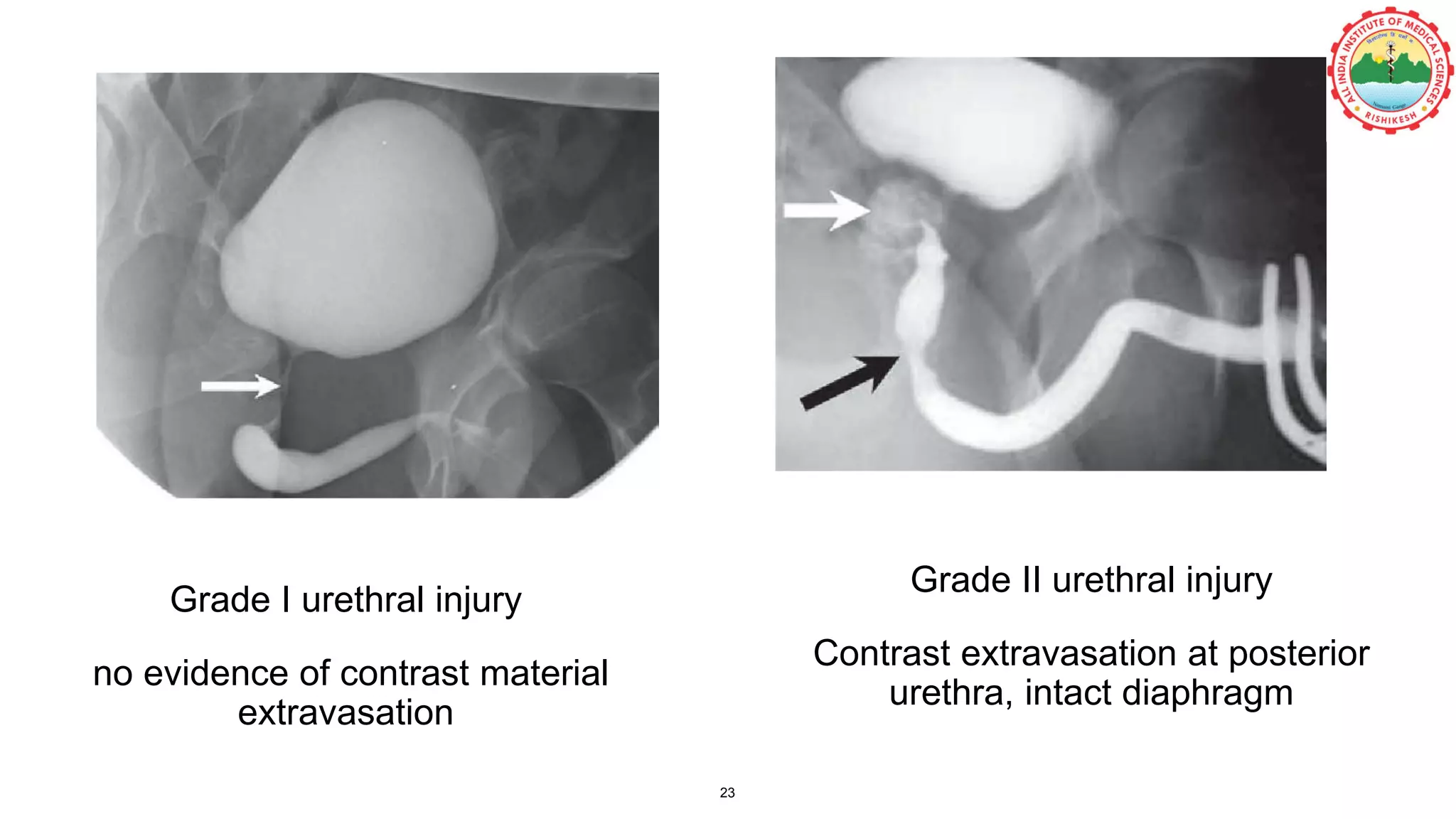 Grade II urethral injury
Contrast extravasation at posterior
urethra, intact diaphragm
Grade I urethral injury
no evidence of contrast material
extravasation
23
 
