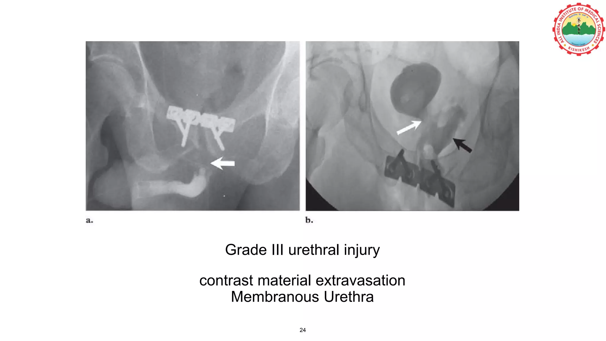 Grade III urethral injury
contrast material extravasation
Membranous Urethra
24
 