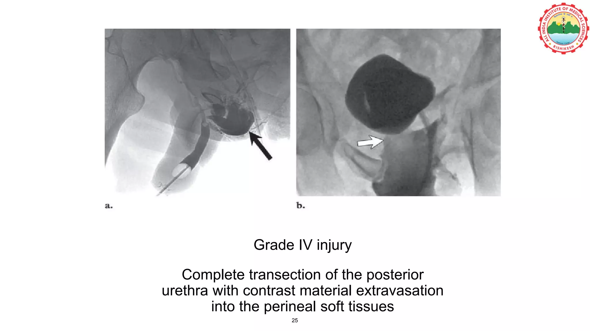 Grade IV injury
Complete transection of the posterior
urethra with contrast material extravasation
into the perineal soft tissues
25
 