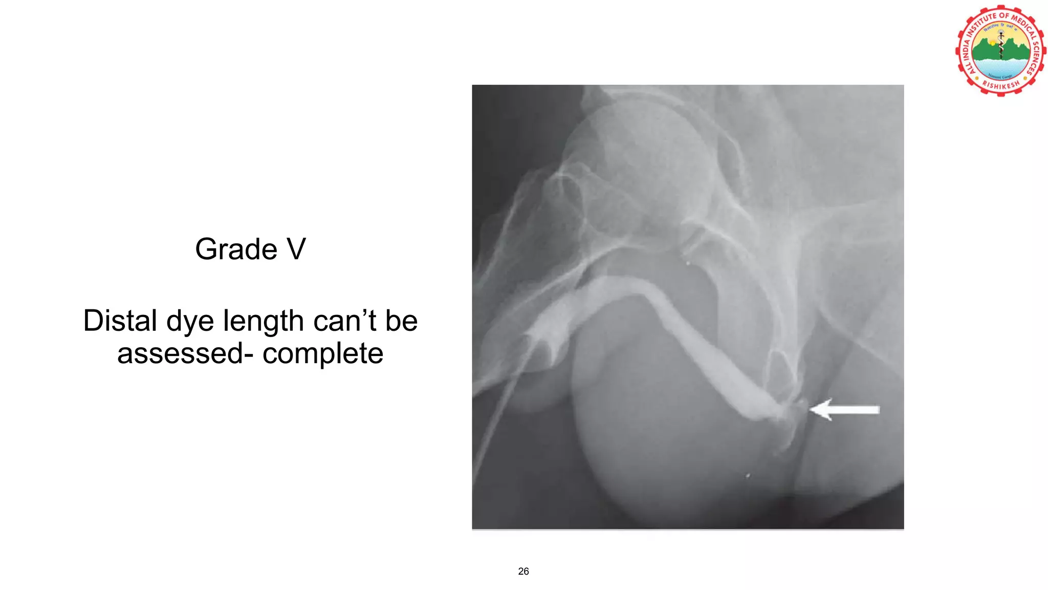 Grade V
Distal dye length can’t be
assessed- complete
26
 