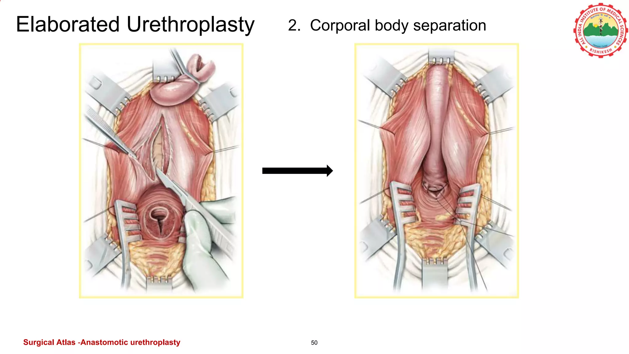 50
Elaborated Urethroplasty 2. Corporal body separation
Surgical Atlas -Anastomotic urethroplasty
 