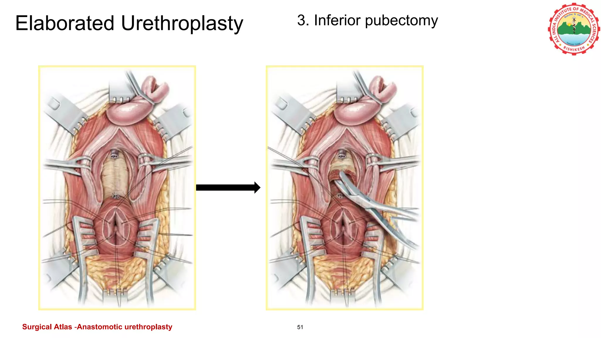 51
Elaborated Urethroplasty 3. Inferior pubectomy
Surgical Atlas -Anastomotic urethroplasty
 