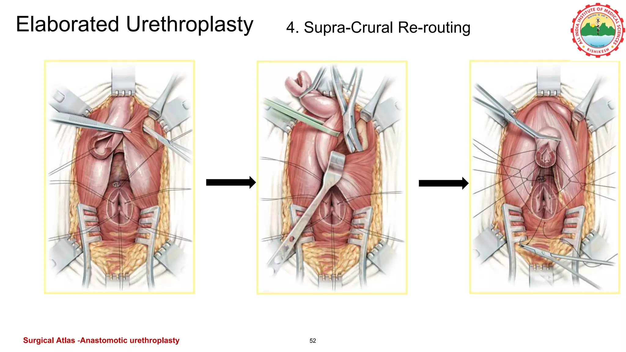 52
Elaborated Urethroplasty 4. Supra-Crural Re-routing
Surgical Atlas -Anastomotic urethroplasty
 