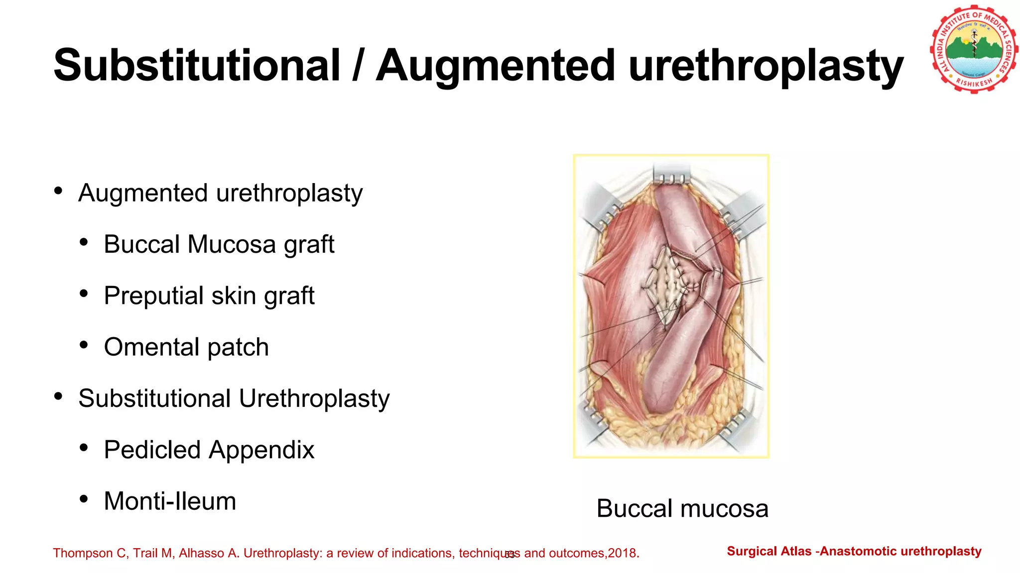 Substitutional / Augmented urethroplasty
53
• Augmented urethroplasty
• Buccal Mucosa graft
• Preputial skin graft
• Omental patch
• Substitutional Urethroplasty
• Pedicled Appendix
• Monti-Ileum Buccal mucosa
Thompson C, Trail M, Alhasso A. Urethroplasty: a review of indications, techniques and outcomes,2018. Surgical Atlas -Anastomotic urethroplasty
 