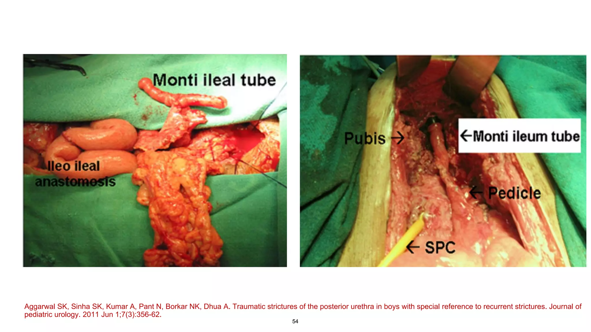 54
Aggarwal SK, Sinha SK, Kumar A, Pant N, Borkar NK, Dhua A. Traumatic strictures of the posterior urethra in boys with special reference to recurrent strictures. Journal of
pediatric urology. 2011 Jun 1;7(3):356-62.
 