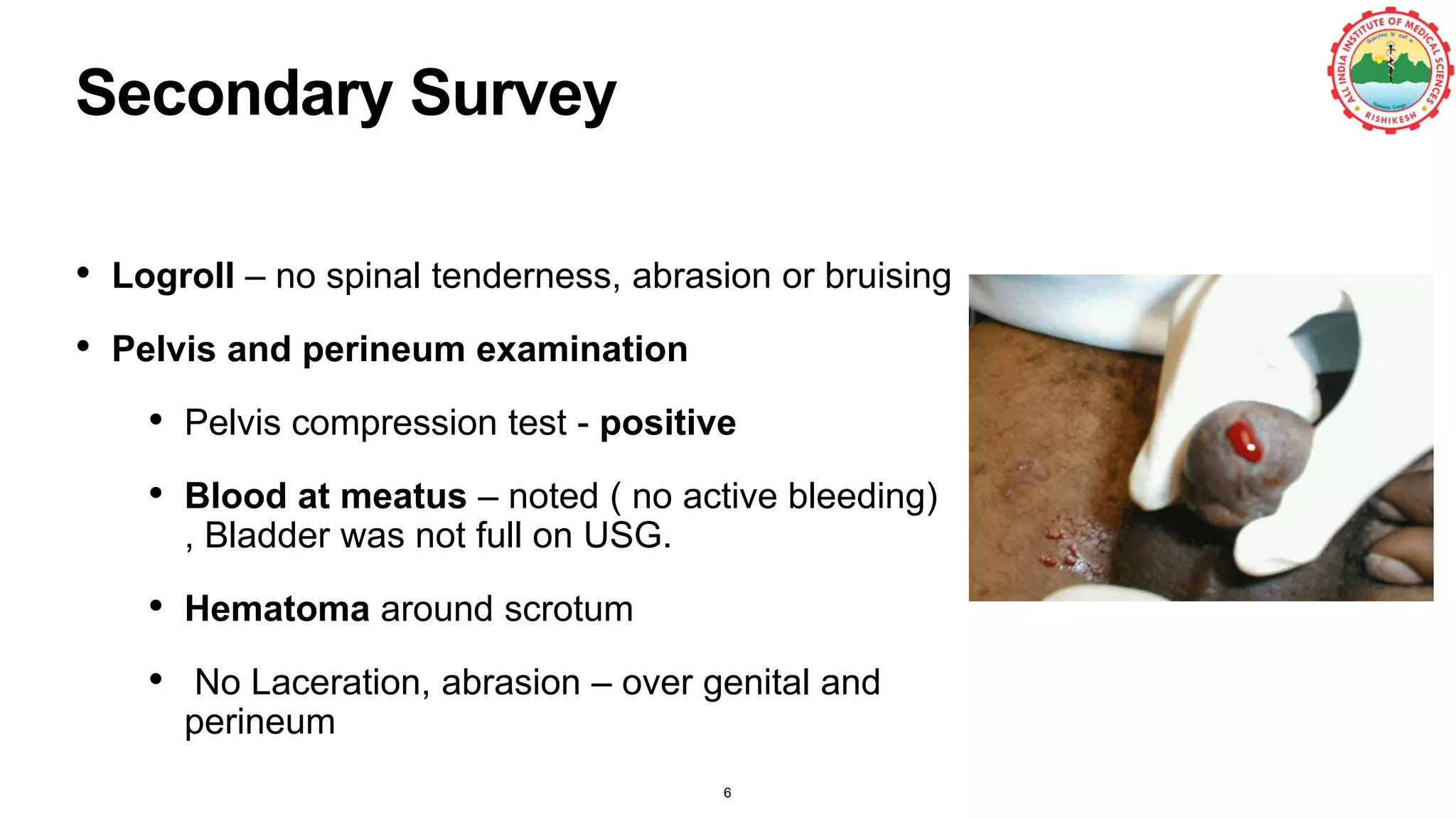 Secondary Survey
• Logroll – no spinal tenderness, abrasion or bruising
• Pelvis and perineum examination
• Pelvis compression test - positive
• Blood at meatus – noted ( no active bleeding)
, Bladder was not full on USG.
• Hematoma around scrotum
• No Laceration, abrasion – over genital and
perineum
6
 