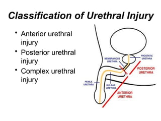 Urethral Trauma for postgraduate by Professor Dr. Mohamed Hindawy ...
