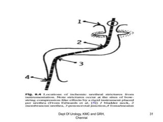Urethra stricture etiopathogenesis & evaluation | PDF