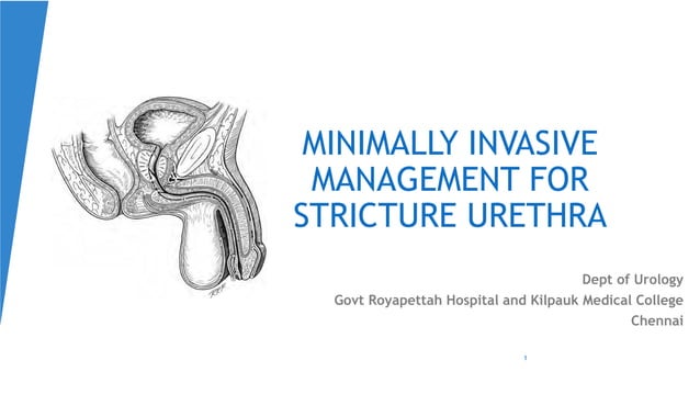 Urethra stricture management- minimally invasive | PDF