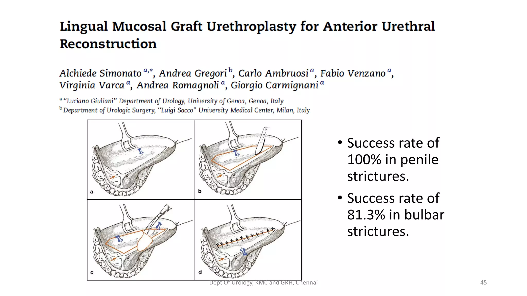 Urethra stricture overview | PDF
