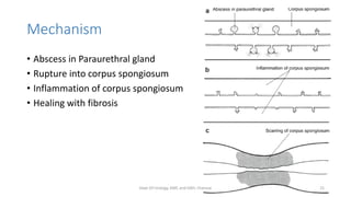 Mechanism
• Abscess in Paraurethral gland
• Rupture into corpus spongiosum
• Inflammation of corpus spongiosum
• Healing with fibrosis
Dept Of Urology, KMC and GRH, Chennai 21
 