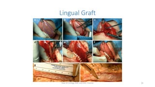 Lingual Graft
Dept Of Urology, KMC and GRH, Chennai 44
 