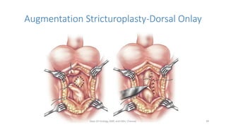 Augmentation Stricturoplasty-Dorsal Onlay
Dept Of Urology, KMC and GRH, Chennai 49
 